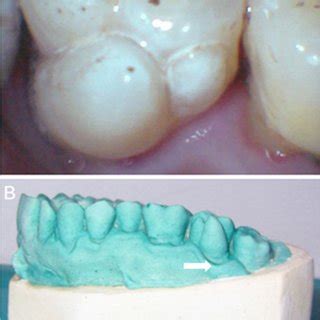 (PDF) Paramolar tubercle: A diversity in canal configuration identified ...