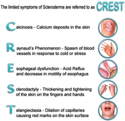 CREST Syndrome - a form of scleroderma that is a combination of calcinosis, Raynaud's phenomenon ...