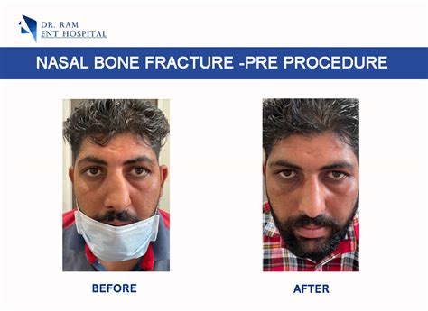 Fracture Nasal Bone Treatment | Treatment of Nasal Fracture Ropar