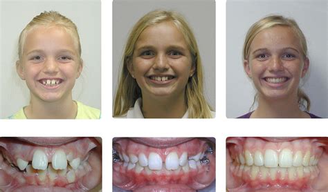 Orthodontic Before and After Photos | Brodsky Orthodontics