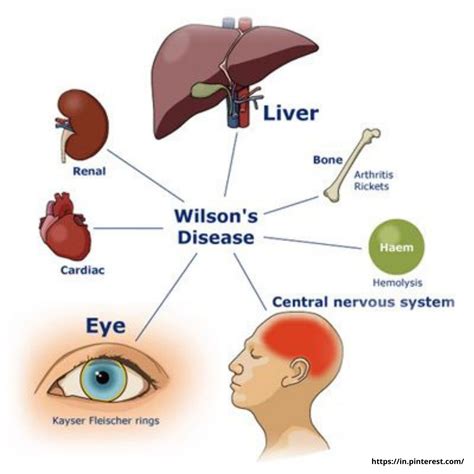 All you need to know about Wilson's Disease. : u/Dr_Jariwala