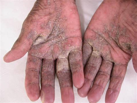 Psoriasis treatment: Norwegian scabies.