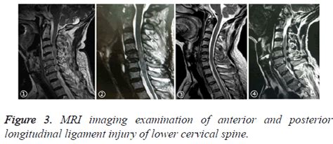 The reliability of MRI diagnosis of anterior and posterior longitudinal ...