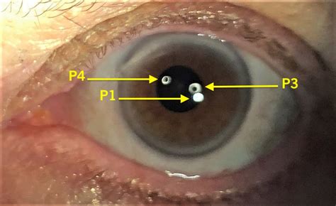 What Is Causing the Twinkle in a Patient’s Eye? | Consultant360