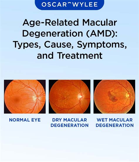 Age-Related Macular Degeneration (AMD): Types, Cause, Symptoms, and ...