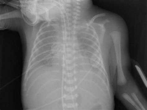 Neonatal respiratory distress syndrome chest x ray - wikidoc
