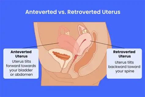 Anteverted Uterus: What Is It, Causes, Fertility, and More