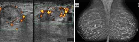 Mastitis - Radiology | UCLA Health