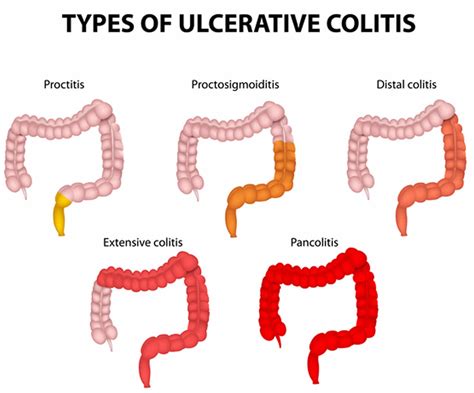 Pancolitis causes, symptoms, complications, diagnosis & treatment