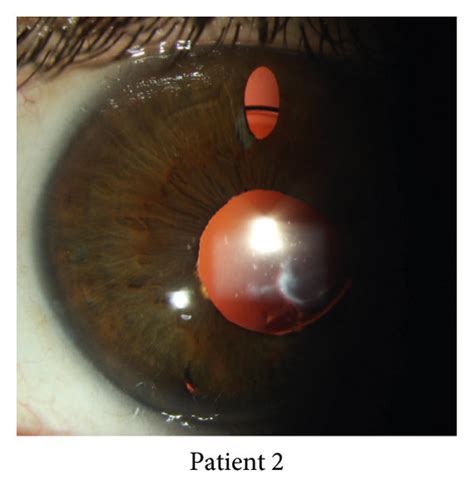 Patient 1: (a) preoperative aphakia with some degree of correctopia and... | Download Scientific ...