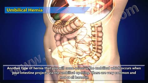 3D Video of Different Types of Hernia - YouTube