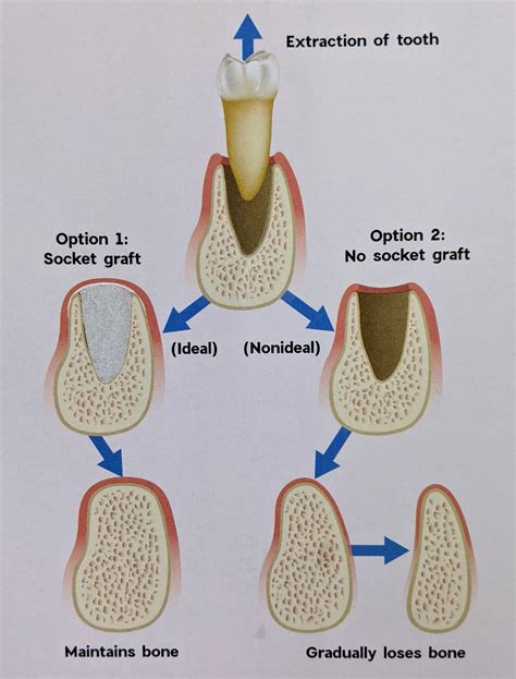 Bone Loss and Facial Changes After Tooth Loss - Grateful Dental