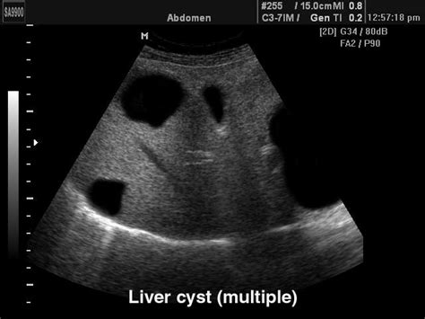Атлас УЗИ • Поликистоз печени, B-режим, эхограмма №152