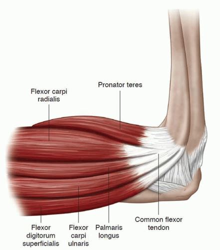 Elbow Common Extensor Tendon Tear