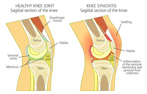 Synovitis of the Knee | Joint Inflammation | Orthopedic Knee Specialist ...