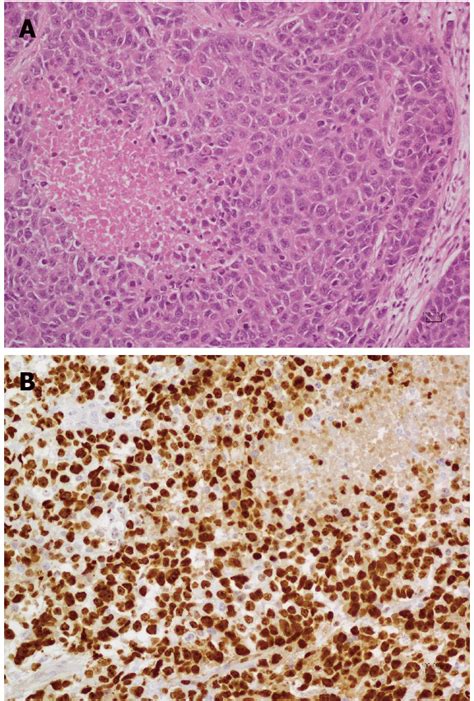 Shows a large cell poorly differentiated neuroendocrine carcinoma of ...