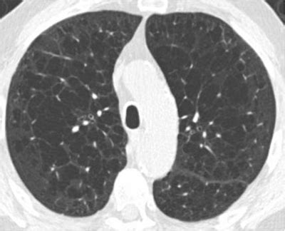 Emphysema-related COPD on CT signals higher malignancy risk - Scan For Life