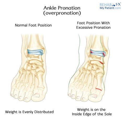 Ankle Pronation (Overpronation) | Rehab My Patient