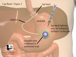 Lap Band Inflation Port - Trial Image Inc.