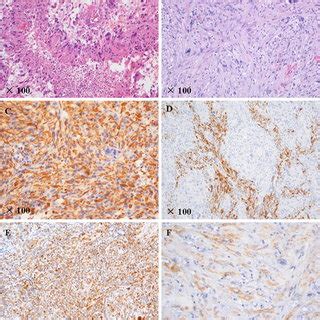 Histology of glioblastoma multiforme and gliosarcoma are shown. a ...