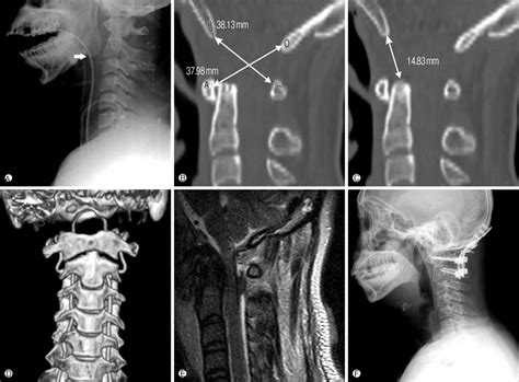 Atlanto Occipital Joint Xray