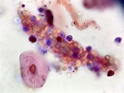 Urine Sediment of the Month: Mixed Cellular Casts - Renal Fellow Network