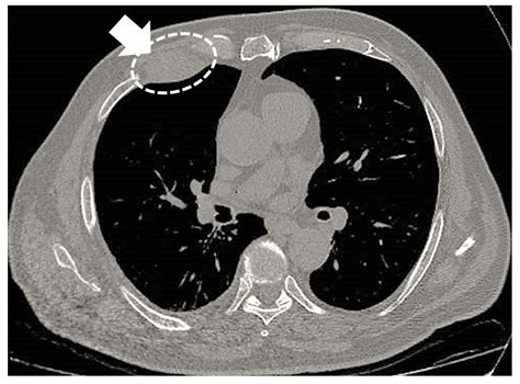 Cystic Mesothelioma Histology