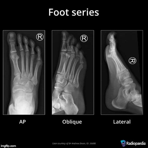 EMRad: Radiologic Approach to the Traumatic Foot X-ray