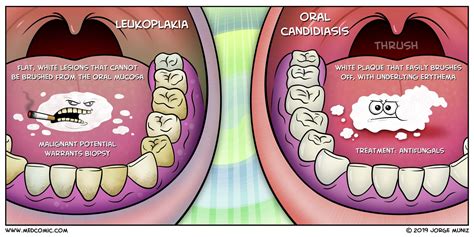 Oral Leukoplakia