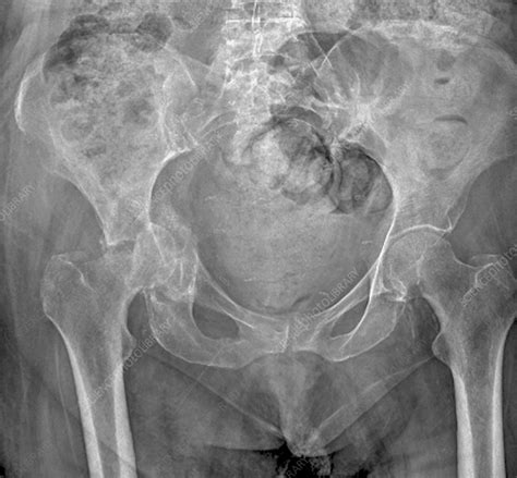 'Pelvic fracture, X-ray' - Stock Image - C002/6549 - Science Photo Library