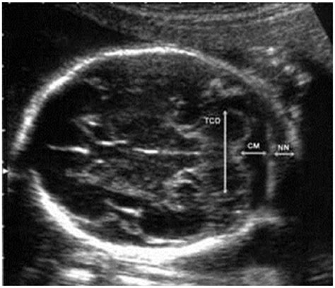 Sonographic Reference Values for Fetal Transverse Cerebellar Diameter ...