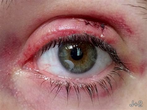 Chalazion.Me | Surgical operation for my encysted chalazion