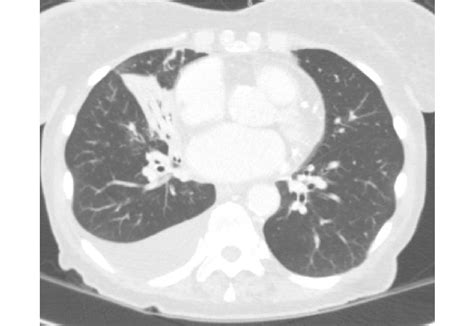 Axial CT image shows consolidation with air bronchogram in the right... | Download Scientific ...