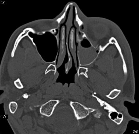 Blow Out Fracture-MDCT - Sumer's Radiology Blog