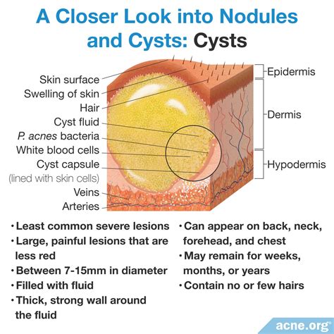 What Is Cystic Acne? - Acne.org