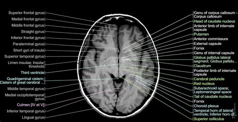 Cross-sectional anatomy of the brain: normal anatomy | e-Anatomy