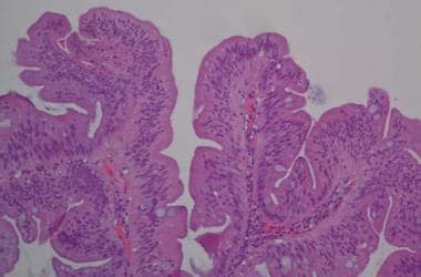 Thyroid Adenoma Histology