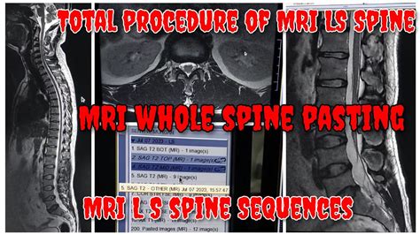 MRI LS Spine Sequence || MRI LS Spine Planning || How to do MRI LS Spine in GE 1.5 T || Prasad ...