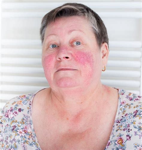 Rosacea Causes and Treatments - Everything You Need to Know