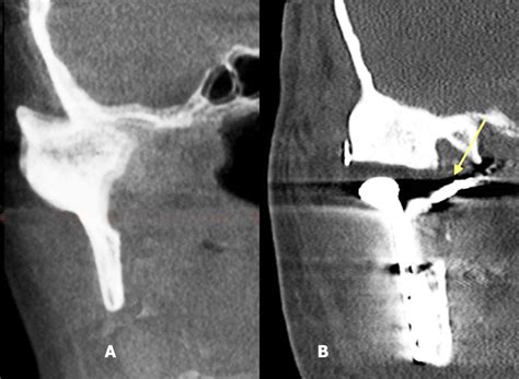 Total Replacement of TMJ in Advanced TMJ Ankylosis - Penn Medicine