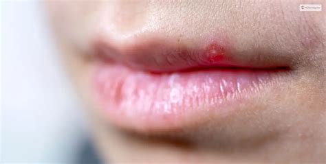 How To Get Rid Of A Pimple On Lip: Treatments Guide - WomenMagazine