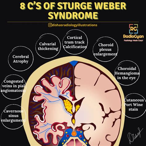 Sturge Weber Syndrome - Visual Mnemonics - RadioGyan