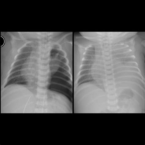 Newborn immediately status post repair of left congenital diaphragmatic hernia | Pediatric ...