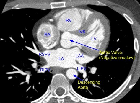 Cardiac CT – Pulmonary veins and left atrium – All About Cardiovascular System and Disorders