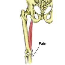 Pes Anserine Tendinopathy - Bursitis | Symptoms & treatment