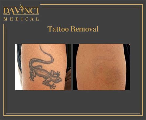 Da Vinci Clinic - Birthmark & Tattoo Removal using PICO Laser