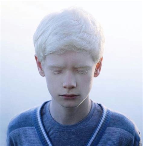 Image about boy in albino. by Hey, Henry on We Heart It Albino Human, Michael Dawson, Vitiligo ...