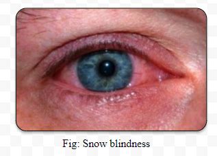 What do you understand by snow blindness?