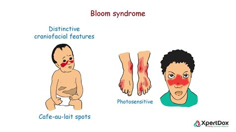 Bloom Syndrome Symptoms