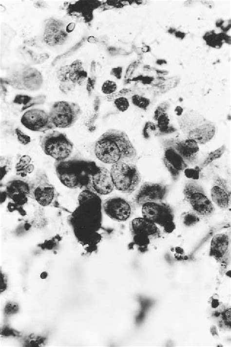 Figure 1 from Cytology of Ascitic Fluid in a Patient with Granulocytic Sarcoma (Extramedullary ...